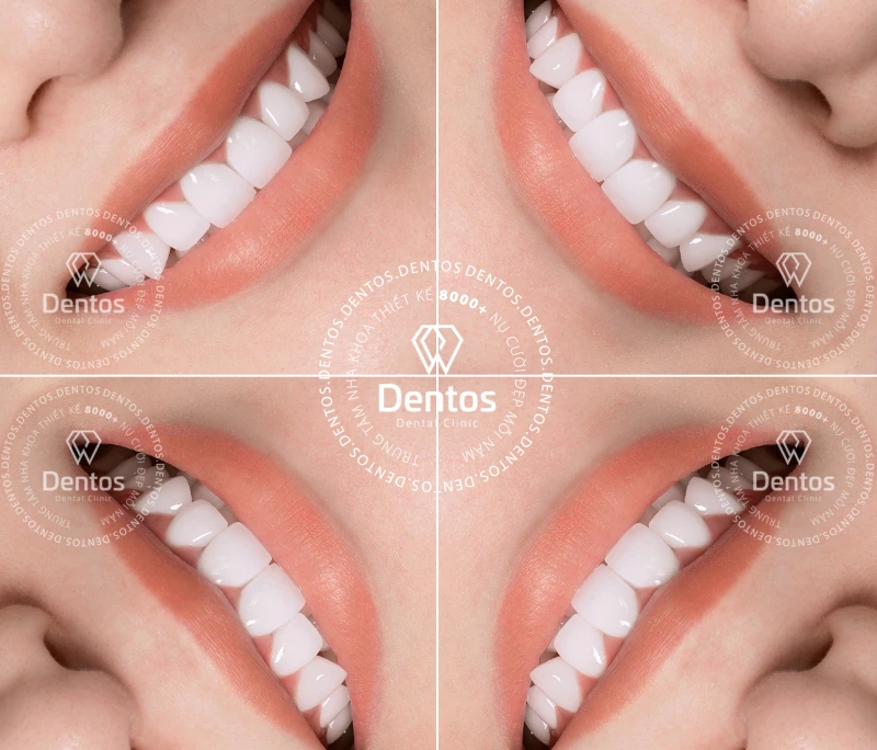 Giá bọc răng sứ hiện nay bao nhiêu tiền? Địa chỉ bọc uy tín tại TP.HCM